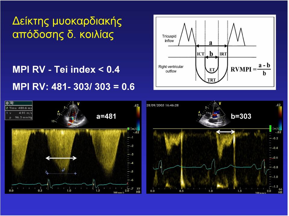 κοιλίας MPI RV - Tei