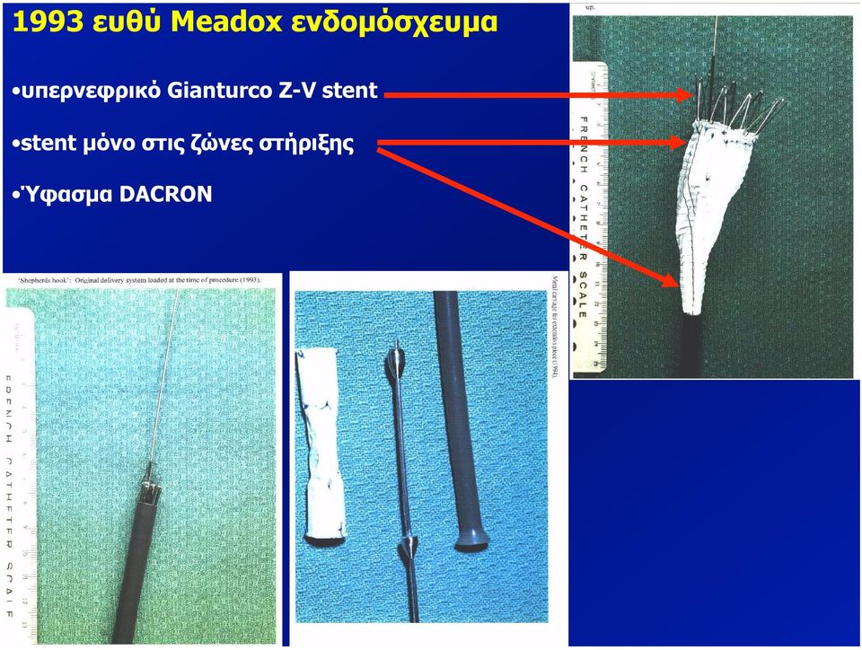 Gianturco Z-V stent stent