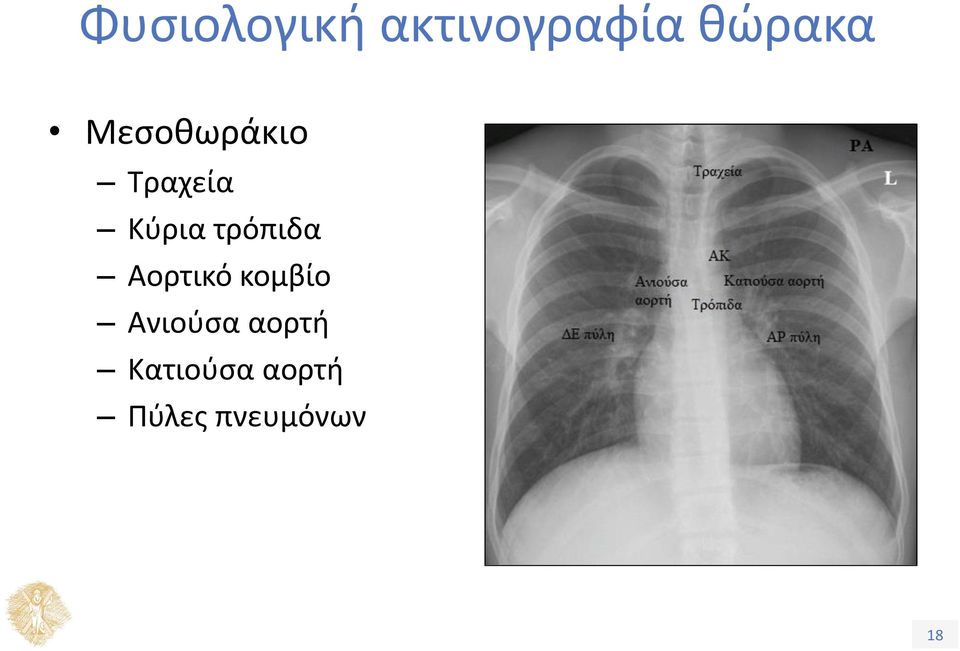 τρόπιδα Αορτικό κομβίο Ανιούσα