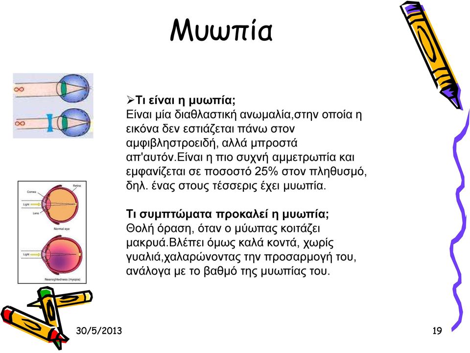 είναι η πιο συχνή αμμετρωπία και εμφανίζεται σε ποσοστό 25% στον πληθυσμό, δηλ. ένας στους τέσσερις έχει μυωπία.