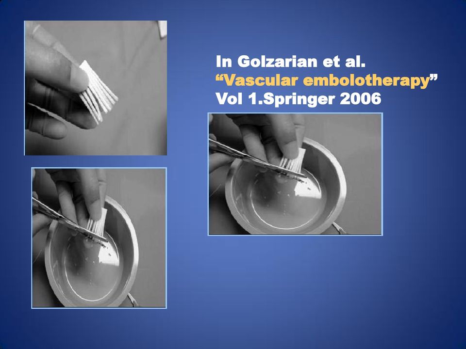 embolotherapy