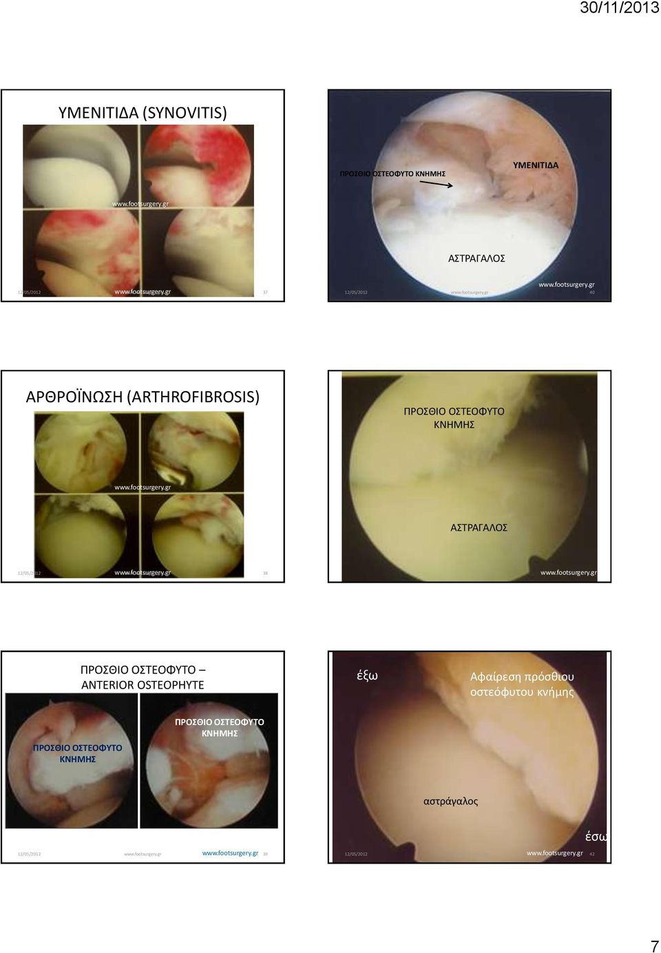 ΠΡΟΣΘΙΟ ΟΣΤΕΟΦΥΤΟ ANTERIOR OSTEOPHYTE έξω Αφαίρεση πρόσθιου οστεόφυτου