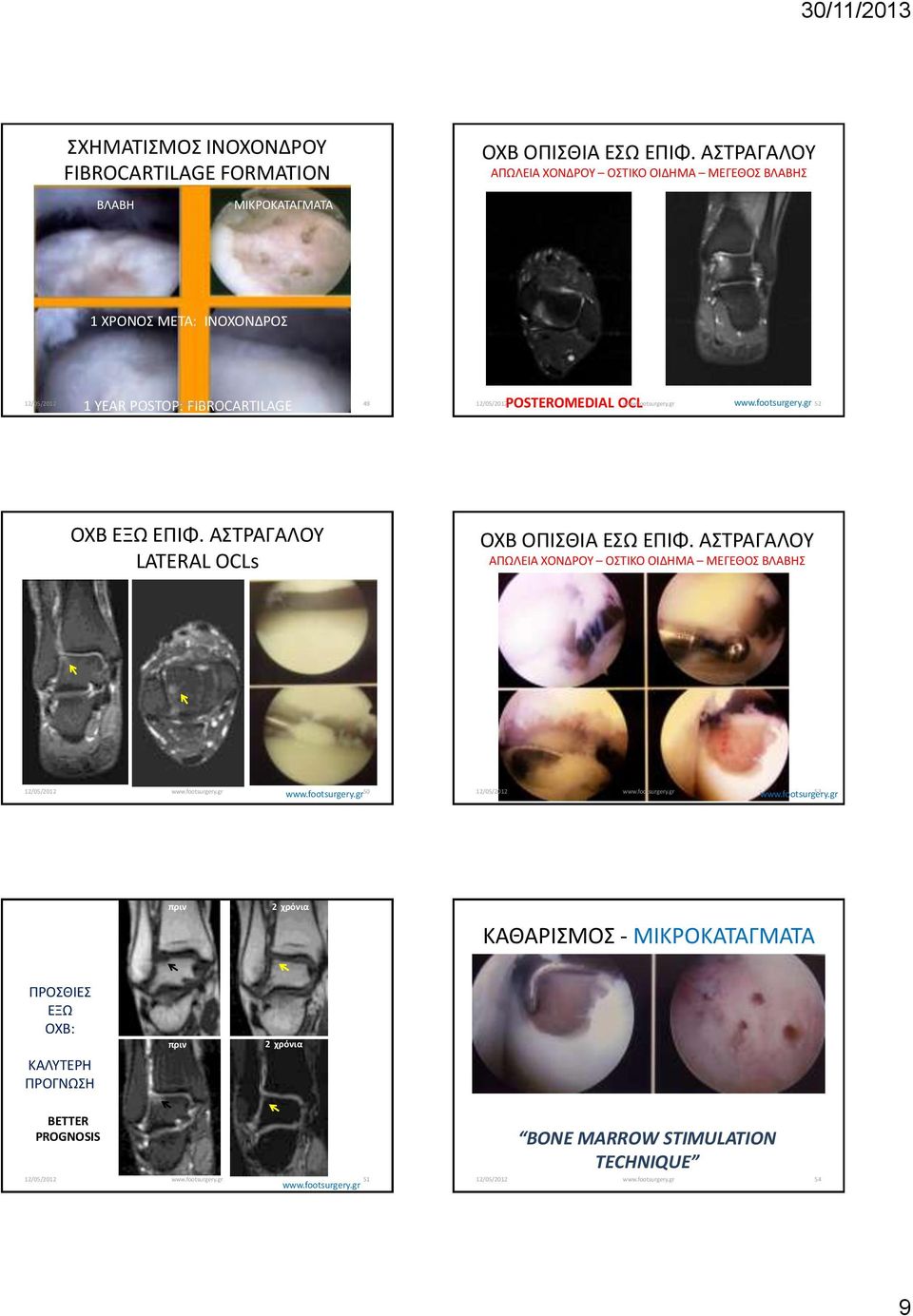 FIBROCARTILAGE POSTEROMEDIAL OCL 52 ΟΧΒ ΕΞΩ ΕΠΙΦ. ΑΣΤΡΑΓΑΛΟΥ LATERAL OCLs ΟΧΒ ΟΠΙΣΘΙΑ ΕΣΩ ΕΠΙΦ.