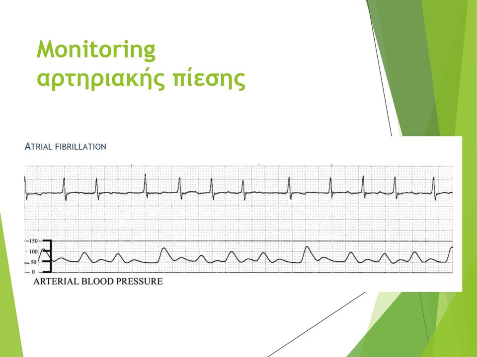 πίεσης Arterial