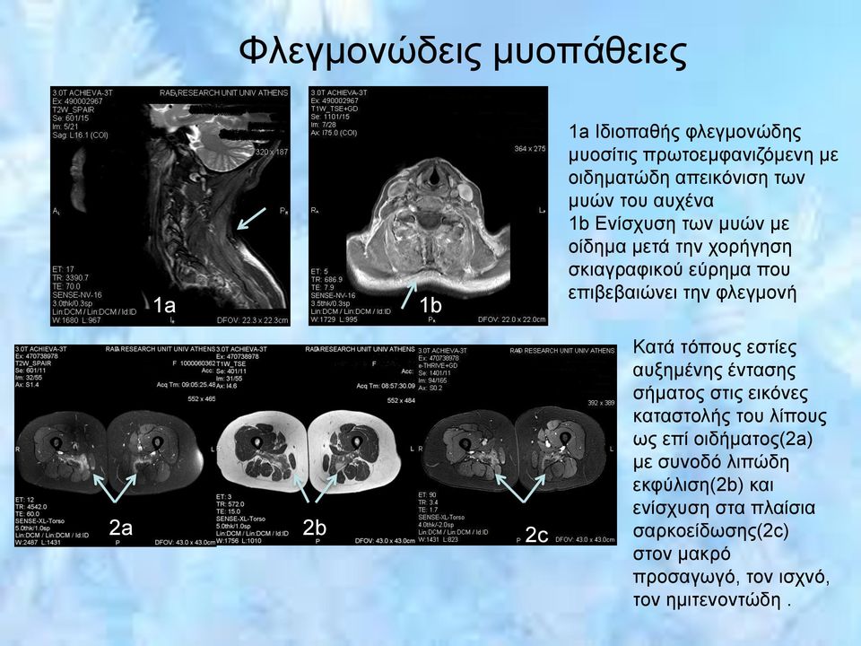 2a 2b 2c Κατά τόπους εστίες αυξημένης έντασης σήματος στις εικόνες καταστολής του λίπους ως επί οιδήματος(2a) με