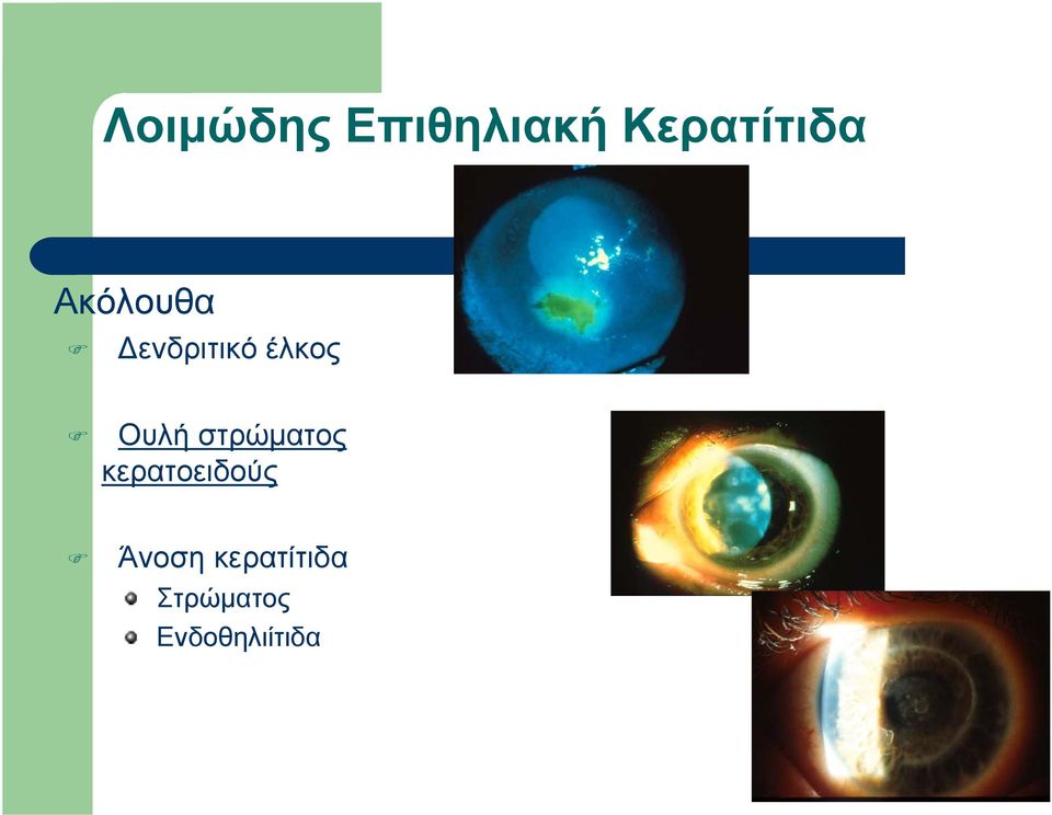 στρώματος κερατοειδούς Άνοση
