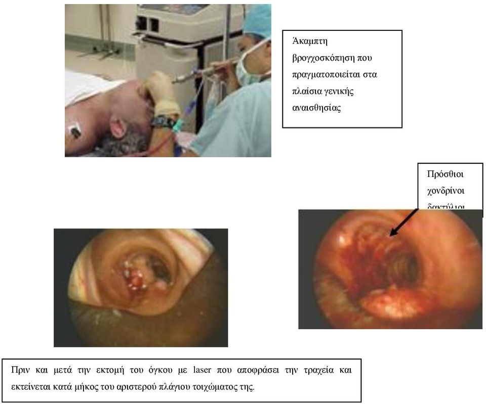 μετά την εκτομή του όγκου με laser που αποφράσει την