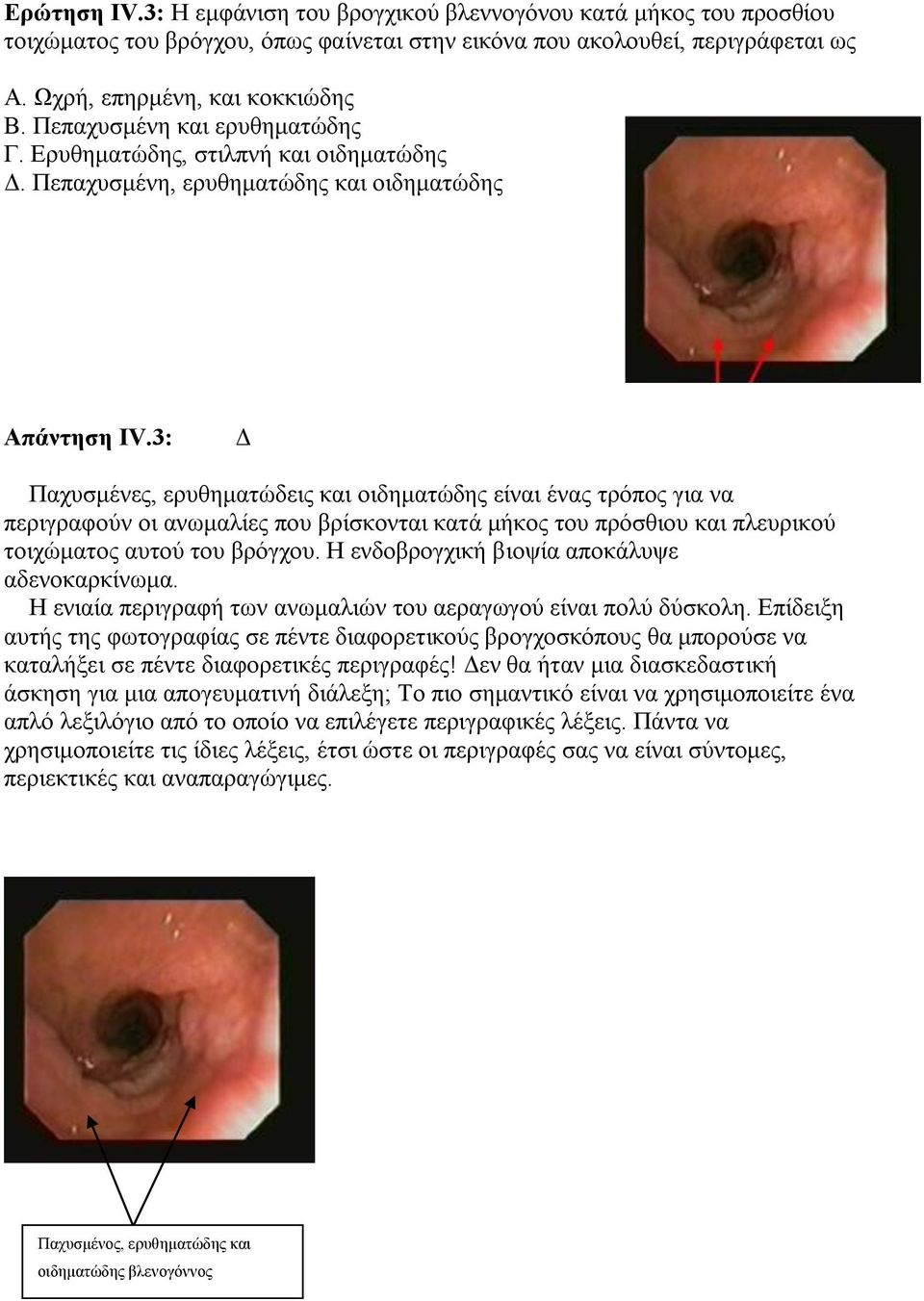 3: Δ Παχυσμένες, ερυθηματώδεις και οιδηματώδης είναι ένας τρόπος για να περιγραφούν οι ανωμαλίες που βρίσκονται κατά μήκος του πρόσθιου και πλευρικού τοιχώματος αυτού του βρόγχου.