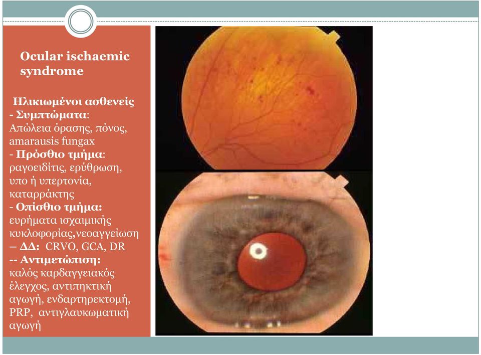 Οπίσθιο τµήµα: ευρήµατα ισχαιµικής κυκλοφορίας,νεοαγγείωση : CRVO, GCA, DR --