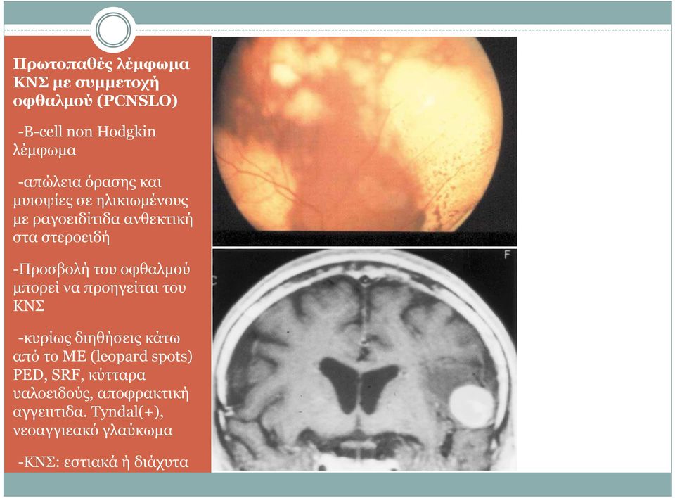 οφθαλµού µπορεί να προηγείται του ΚΝΣ --κυρίως διηθήσεις κάτω από το ΜΕ (leopard spots) PED,