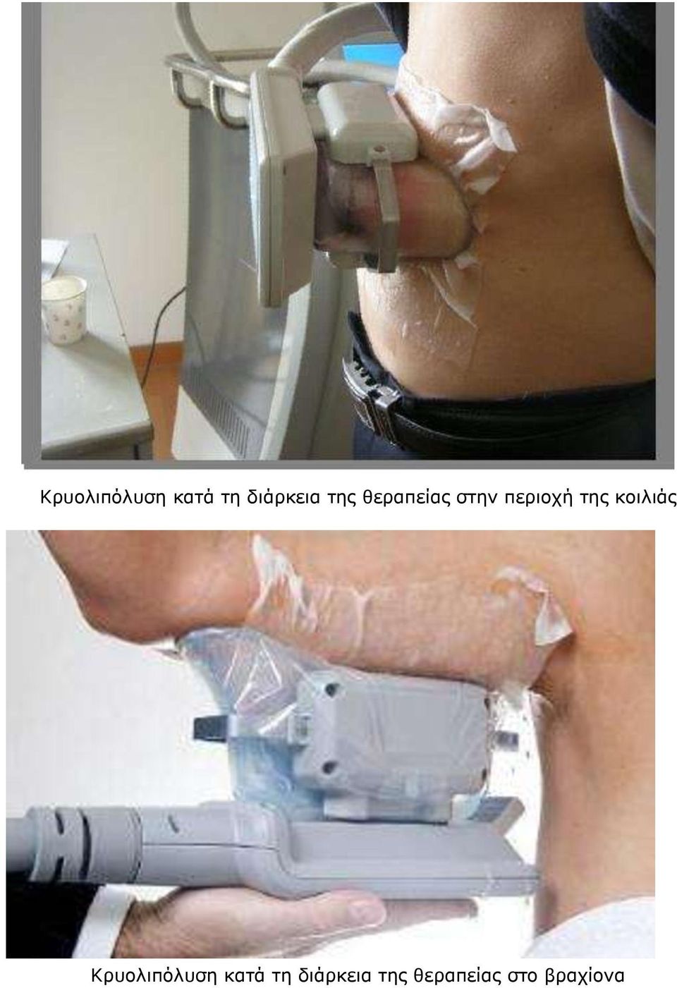 κοιλιάς  της θεραπείας στο