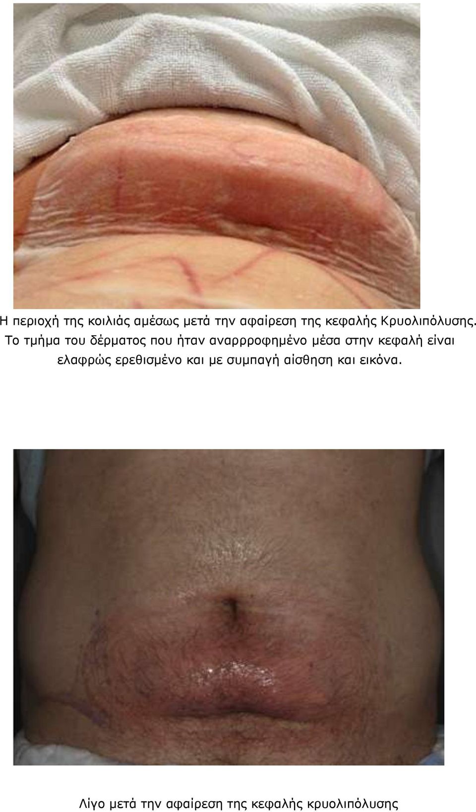 Το τμήμα του δέρματος που ήταν αναρρροφημένο μέσα στην