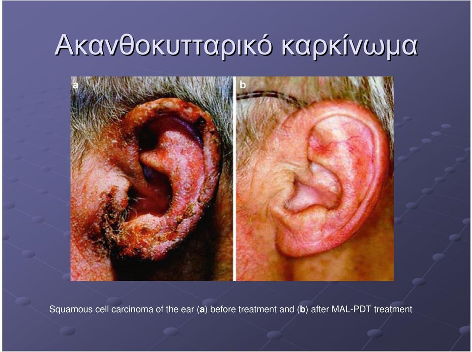 carcinoma of the ear (a)
