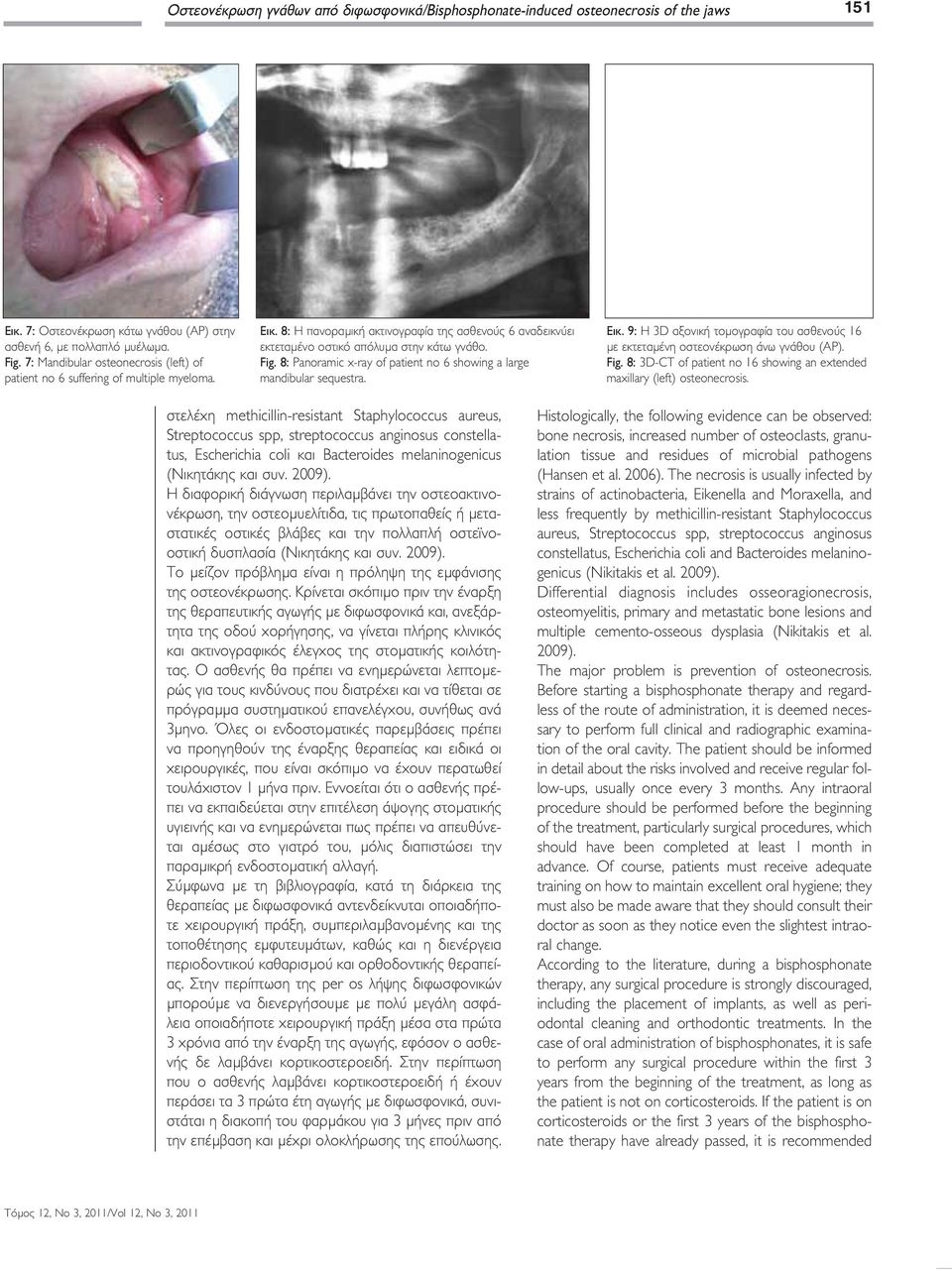 8: Panoramic x-ray of patient no 6 showing a large mandibular sequestra. Εικ. 9: Η 3D αξονική τομογραφία του ασθενούς 16 με εκτεταμένη οστεονέκρωση άνω γνάθου (ΑΡ). Fig.