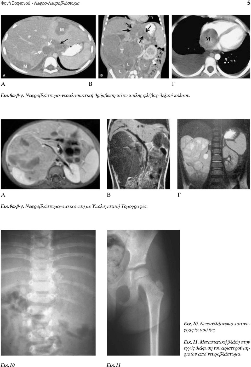 9α-β-γ. Νεφροβλάστωμα-απεικόνιση με Υπολογιστική Τομογραφία. Εικ. 10 Εικ.