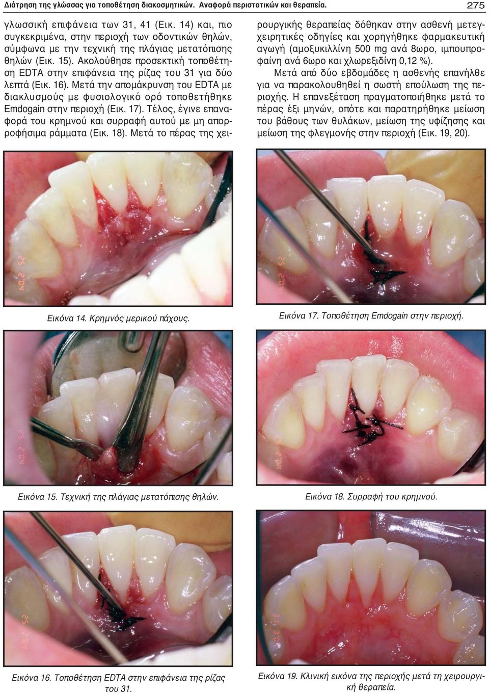 Ακολούθησε προσεκτική τοποθέτηση EDTA στην επιφάνεια της ρίζας του 31 για δύο λεπτά (Εικ. 16). Μετά την απομάκρυνση του EDTA με διακλυσμούς με φυσιολογικό ορό τοποθετήθηκε Emdogain στην περιοχή (Εικ.