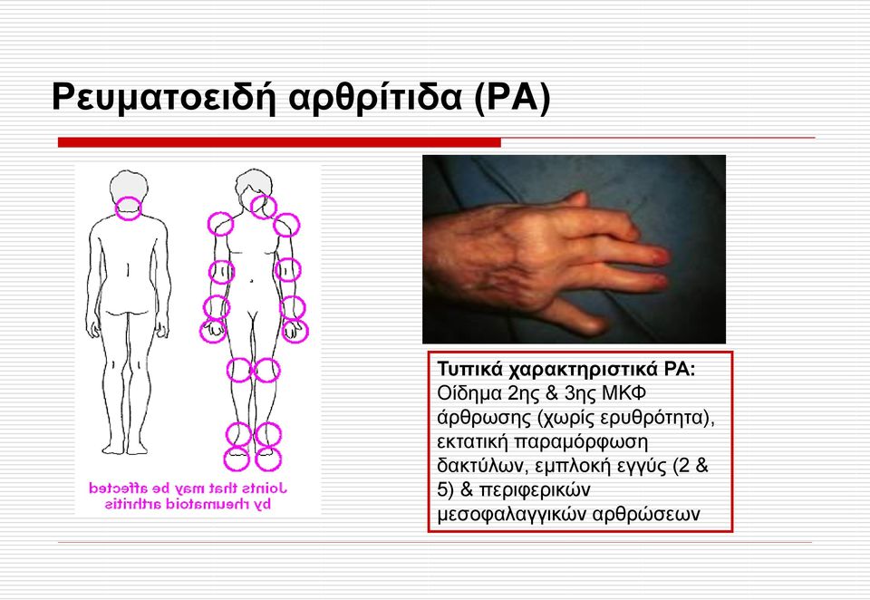 εξπζξόηεηα), εθηαηηθή παξακόξθσζε δαθηύισλ,