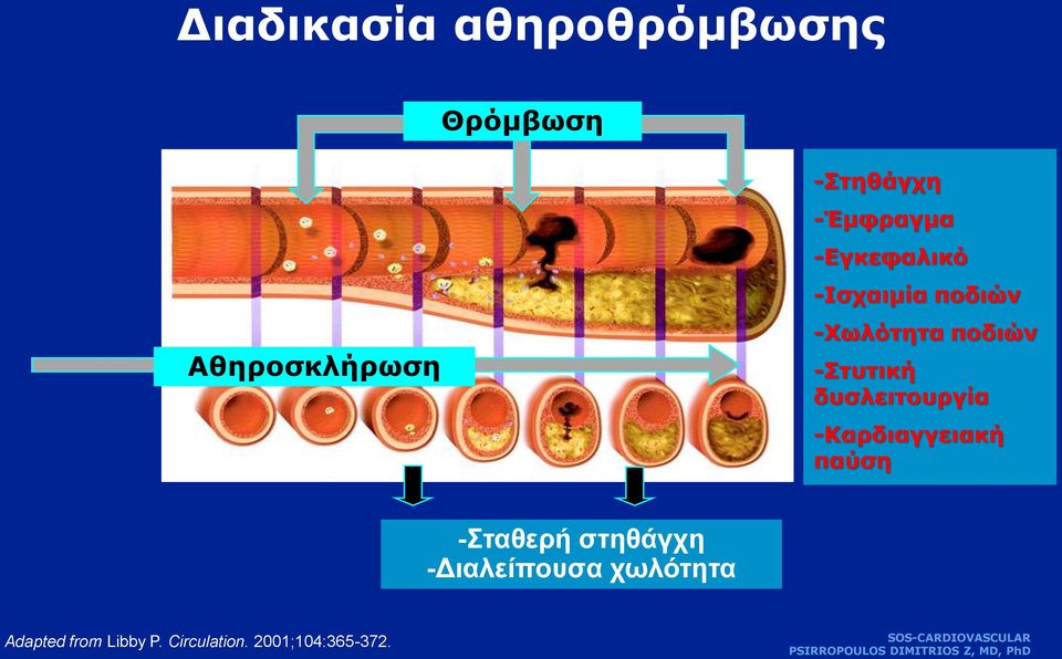 -Στυτική δυσλειτουργία -Καρδιαγγειακή παύση -Σταθερή στηθάγχη