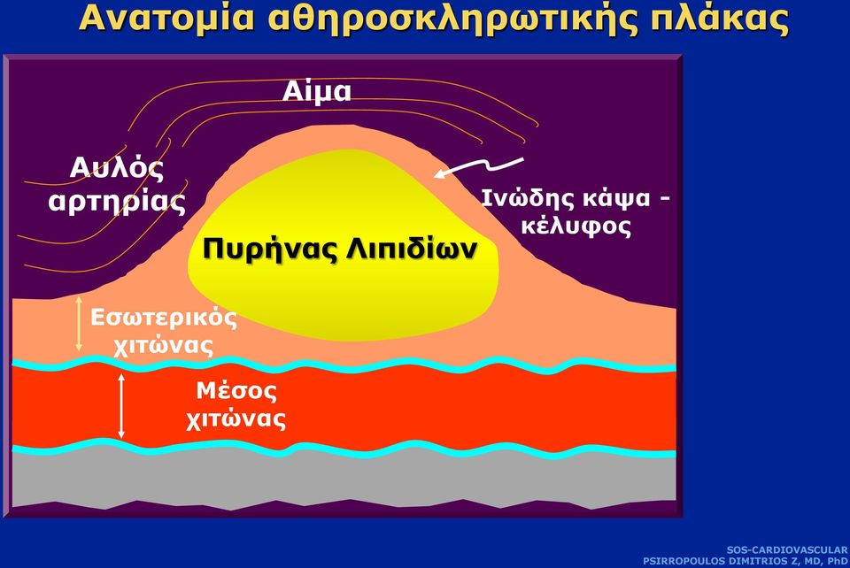 Πυρήνας Λιπιδίων Ινώδης κάψα -