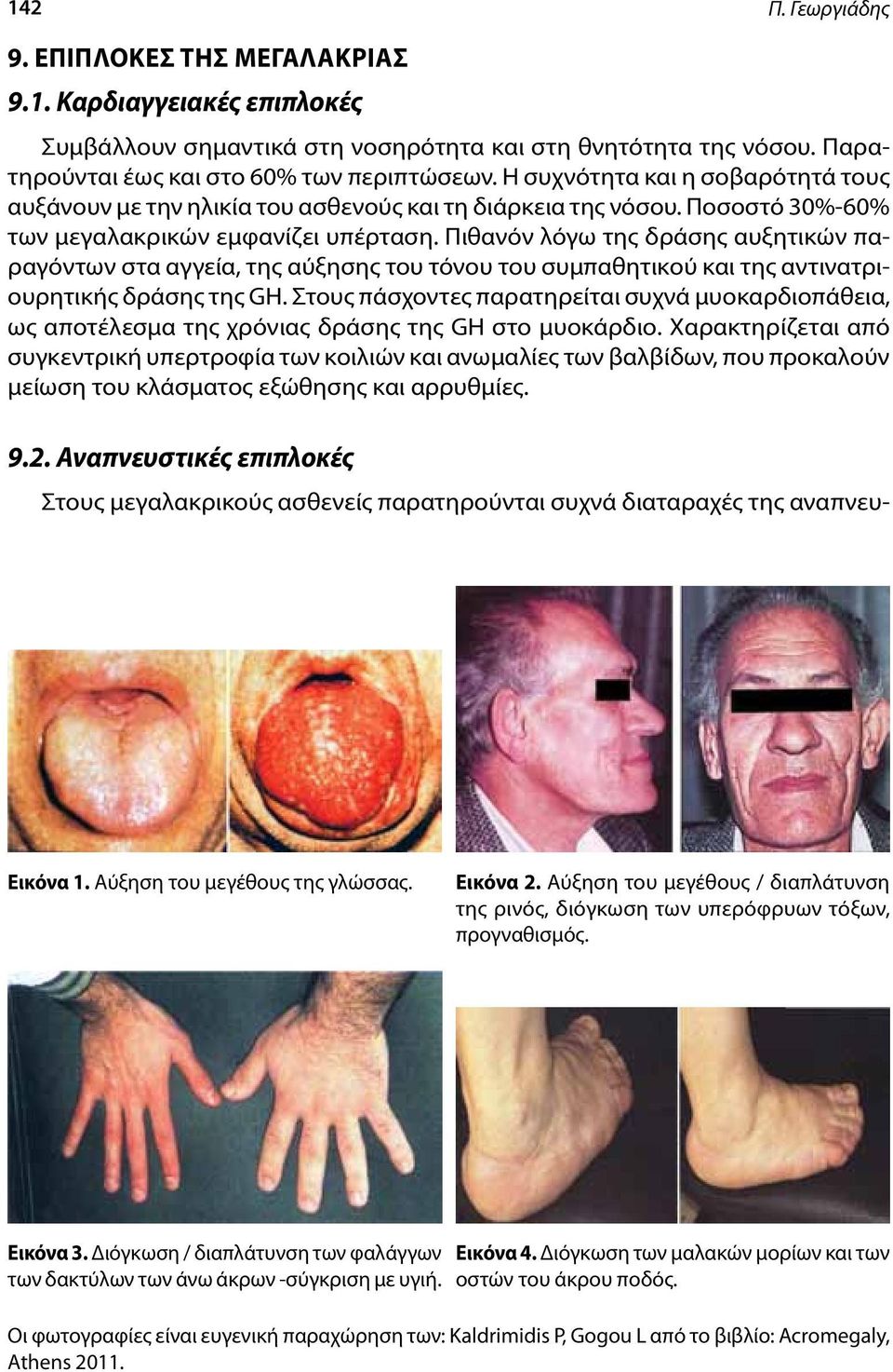 Πιθανόν λόγω της δράσης αυξητικών παραγόντων στα αγγεία, της αύξησης του τόνου του συμπαθητικού και της αντινατριουρητικής δράσης της GH.