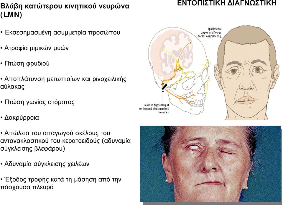 στόματος ακρύρροια Απώλεια του απαγωγού σκέλους του αντανακλαστικού του κερατοειδούς (αδυναμία