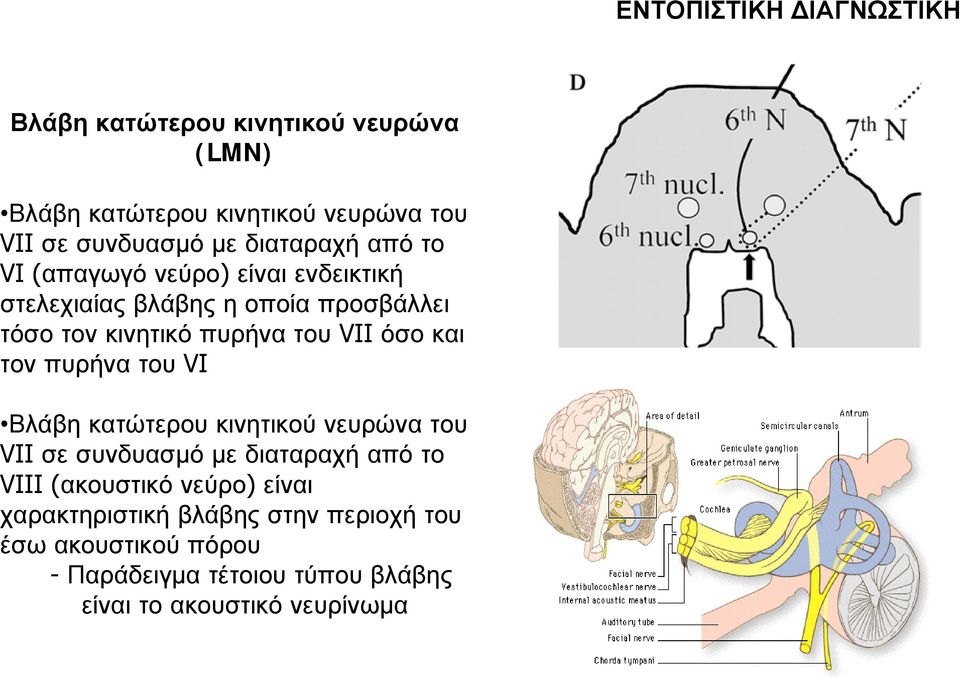 όσο και τον πυρήνα του VI Βλάβη κατώτερου κινητικού νευρώνα του VII σε συνδυασμό με διαταραχή από το VIII (ακουστικό νεύρο)