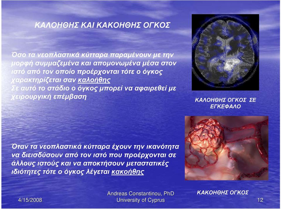 επέμβαση ΚΑΛΟΗΘΗΣ ΟΓΚΟΣ ΣΕ ΕΓΚΕΦΑΛΟ Όταν τα νεοπλαστικά κύτταρα έχουν την ικανότητα να διεισδύσουν από τον ιστό που