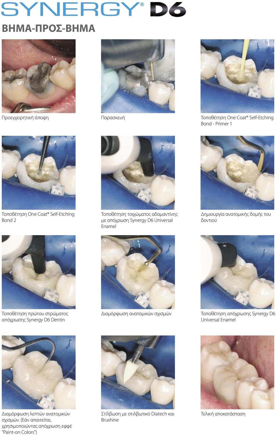 στρώματος απόχρωσης Synergy D6 Dentin Διαμόρφωση ανατομικών σχισμών Τοποθέτηση απόχρωσης Synergy D6 Universal Enamel Διαμόρφωση λεπτών