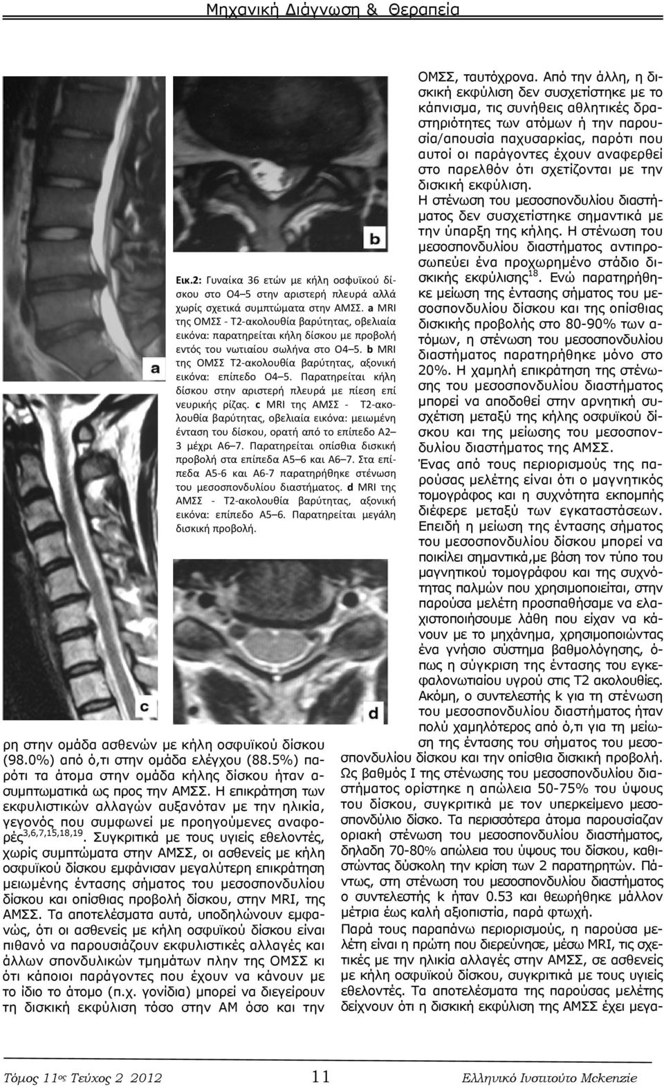 Παρατηρείται κήλη δίσκου στην αριστερή πλευρά με πίεση επί νευρικής ρίζας. c MRI της ΑΜΣΣ T2 ακολουθία βαρύτητας, οβελιαία εικόνα: μειωμένη ένταση του δίσκου, ορατή από το επίπεδο Α2 3 μέχρι Α6 7.