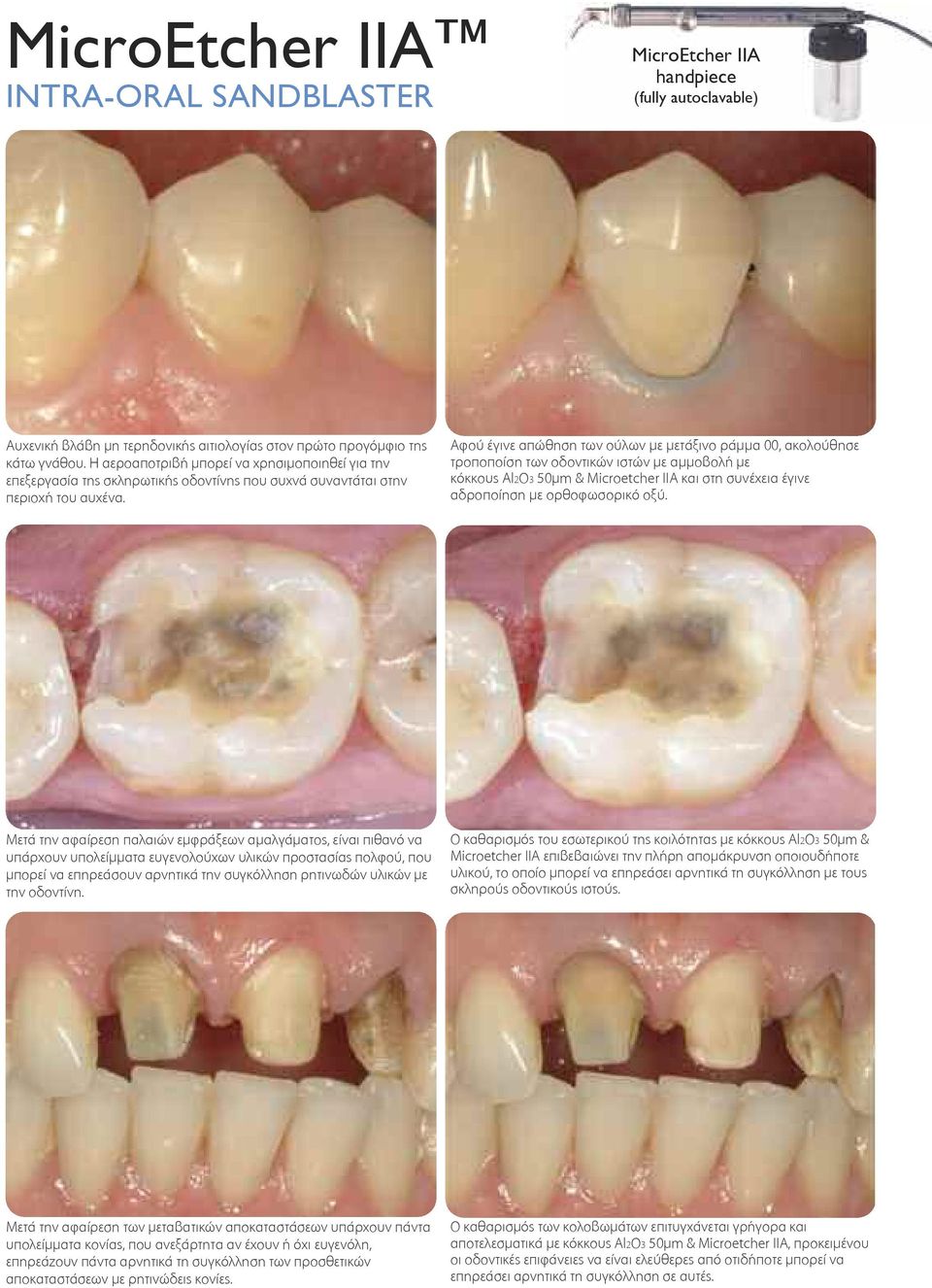 Αφού έγινε απώθηση των ούλων με μετάξινο ράμμα 00, ακολούθησε τροποποίση των οδοντικών ιστών με αμμοβολή με κόκκους Al2O3 50μm & Microetcher IIA και στη συνέχεια έγινε αδροποίηση με ορθοφωσορικό οξύ.