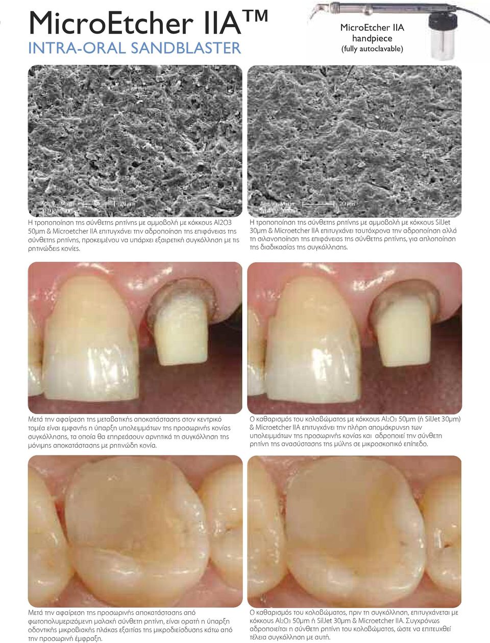 Η τροποποίηση της σύνθετης ρητίνης με αμμοβολή με κόκκους SilJet 30μm & Microetcher IIA επιτυγχάνει ταυτόχρονα την αδροποίηση αλλά τη σιλανοποίηση της επιφάνειας της σύνθετης ρητίνης, για απλοποίηση