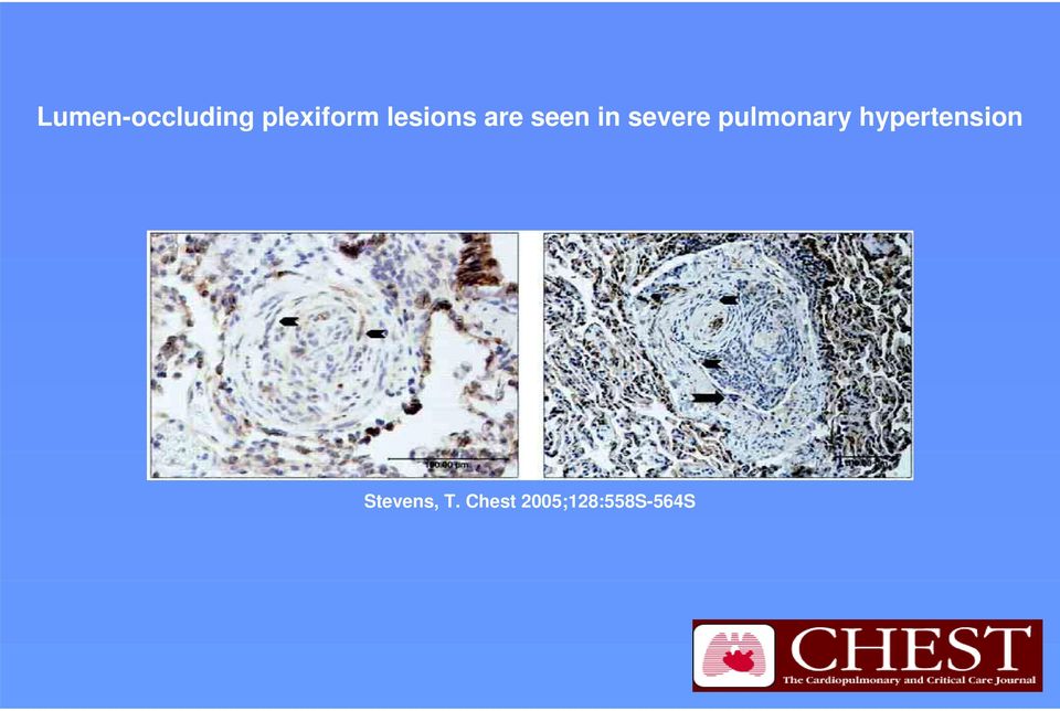 pulmonary hypertension