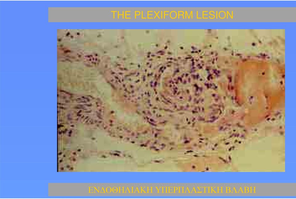 LESION