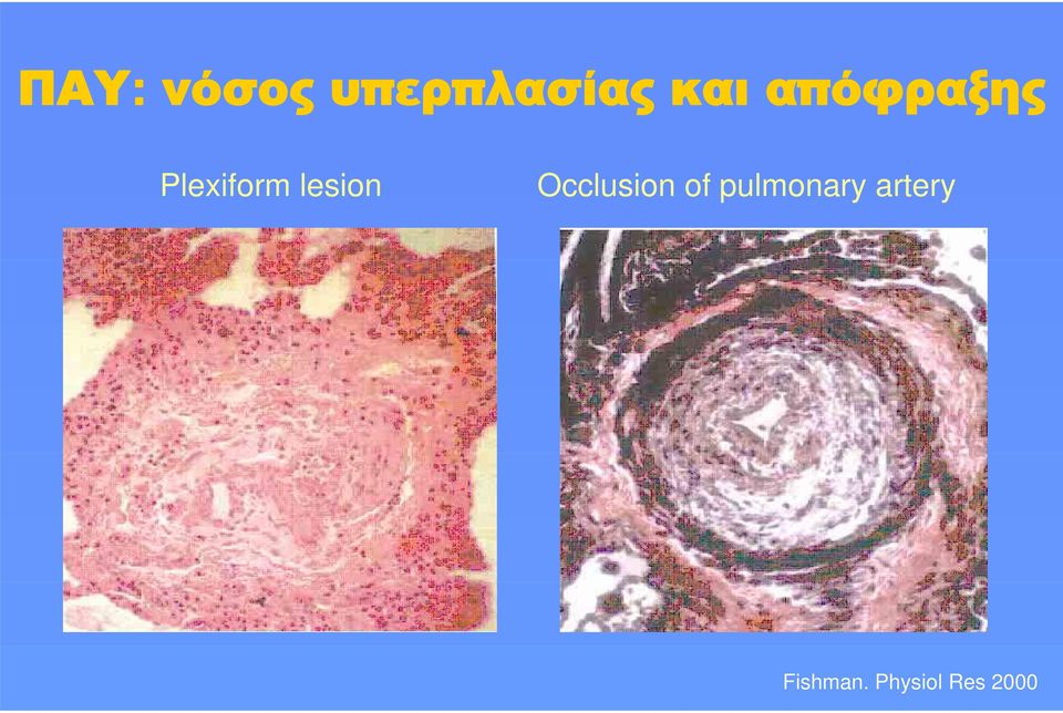 Occlusion of pulmonary