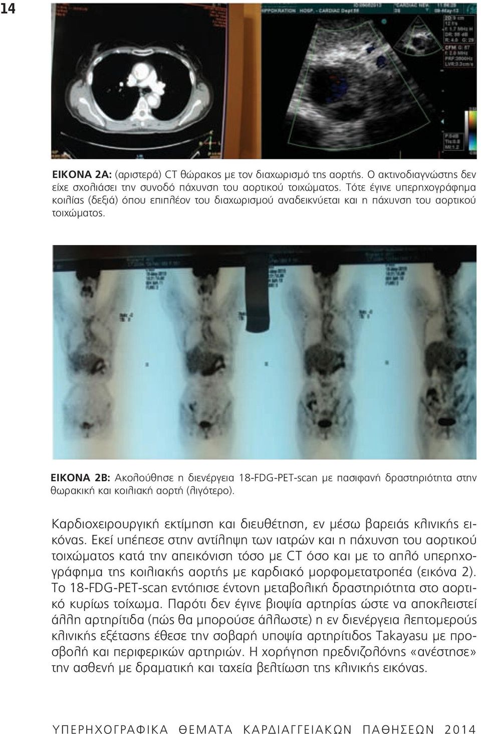 ΕΙΚΟΝΑ 2Β: Ακολούθησε η διενέργεια 18-FDG-PET-scan με πασιφανή δραστηριότητα στην θωρακική και κοιλιακή αορτή (λιγότερο). Καρδιοχειρουργική εκτίμηση και διευθέτηση, εν μέσω βαρειάς κλινικής εικόνας.