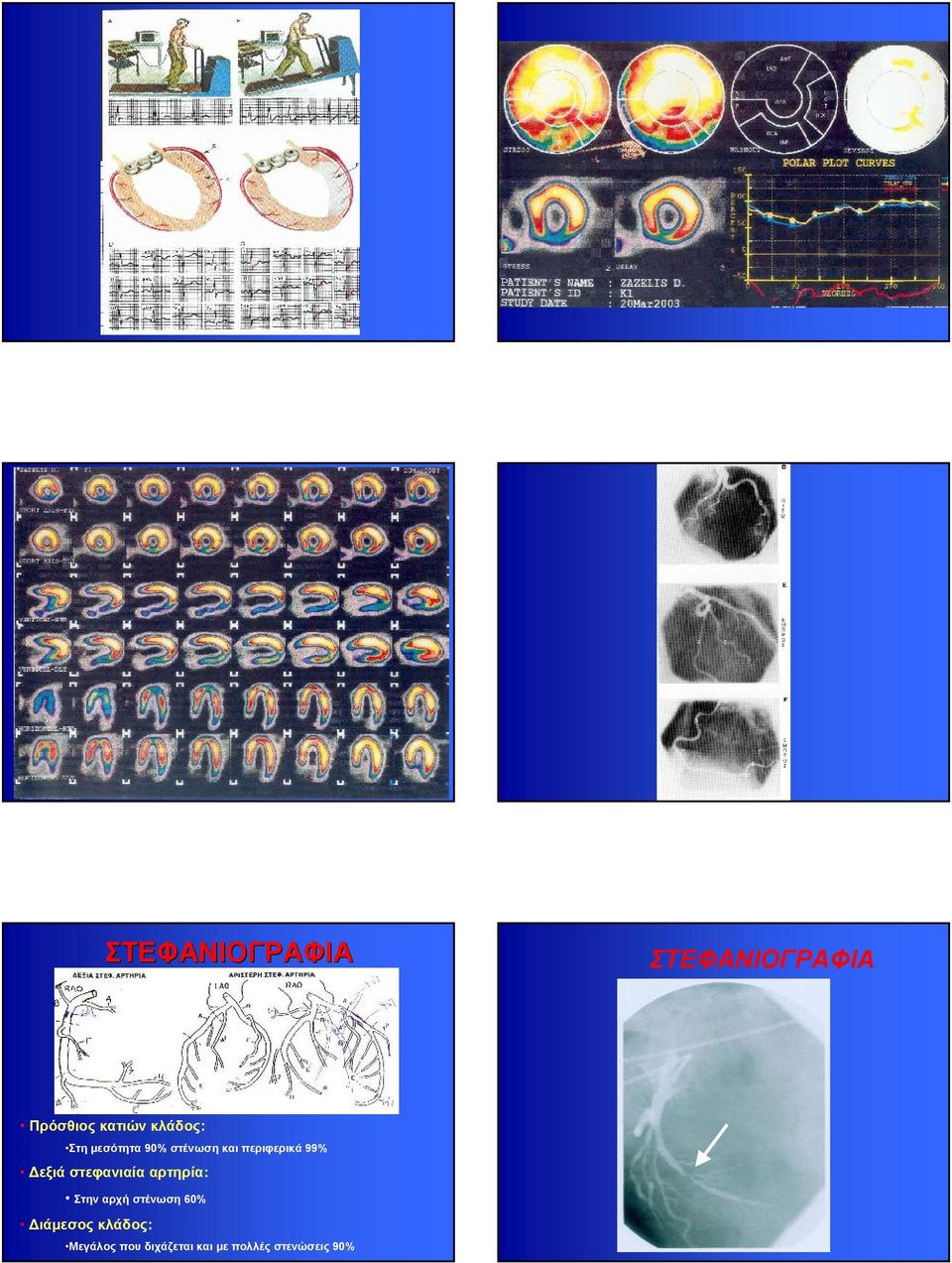 αρτηρία: Στην αρχή στένωση 60% Διάμεσος κλάδος: