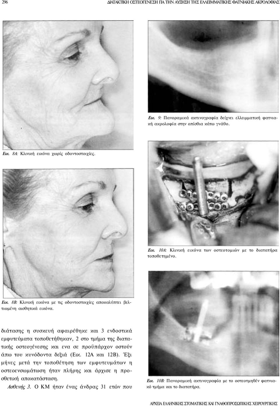 διάτασης η συσκευή αφαιρέθηκε και 3 ενδοστικά εμφυτεύματα τοποθετήθηκαν, 2 στο τμήμα της διατατικής οστεογένεσης και ενα σε προϋπάρχον οστούν άπω του κυνόδοντα δεξιά (Εικ. 12Α και 12Β).