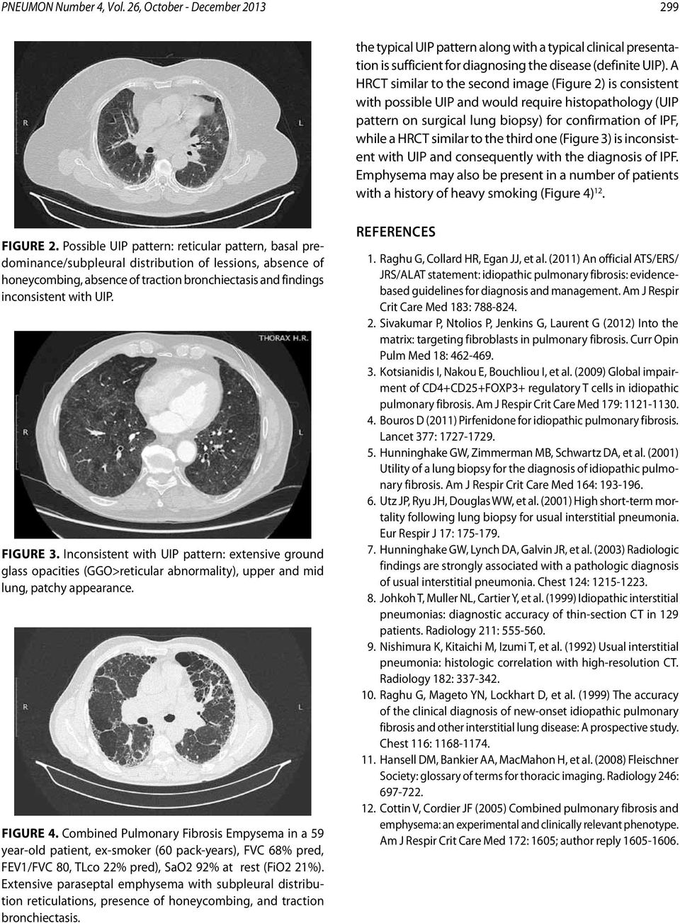 the third one (Figure 3) is inconsistent with UIP and consequently with the diagnosis of IPF. Emphysema may also be present in a number of patients with a history of heavy smoking (Figure 4) 12.