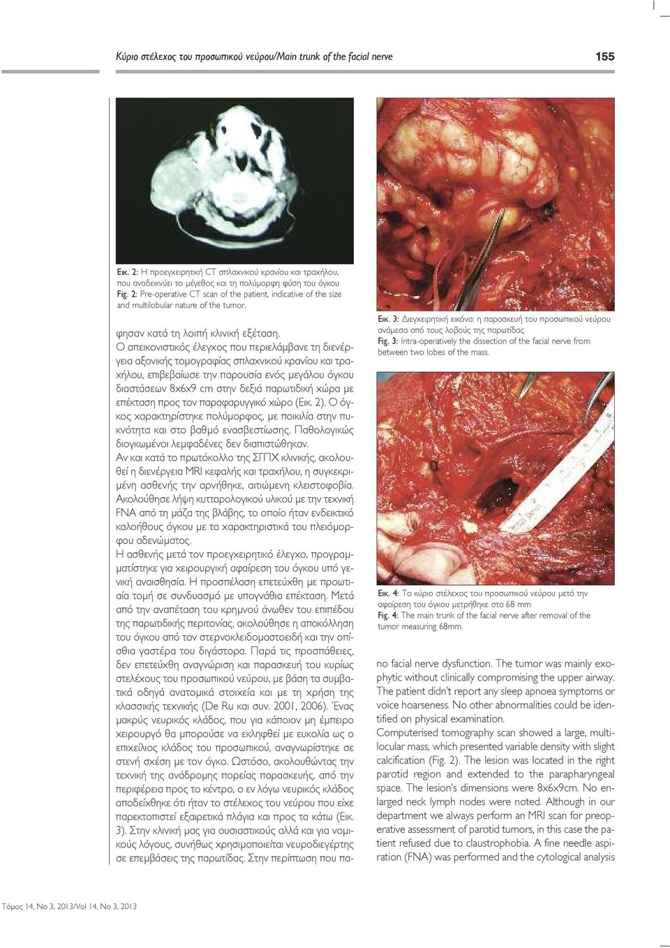 3: Διεγχειρητική εικόνα: η παρασκευή του προσωπικού νεύρου ανάµεσα από τους λοβούς της παρωτίδας Fig. 3: Intra-operatively the dissection of the facial nerve from between two lobes of the mass. Εικ.