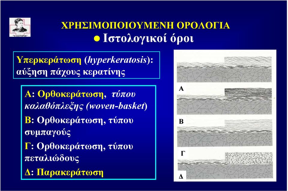 (woven-basket) Β: Ορθοκεράτωση, τύπου συµπαγούς