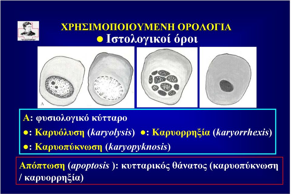 Καρυοπύκνωση (karyopyknosis) Απόπτωση