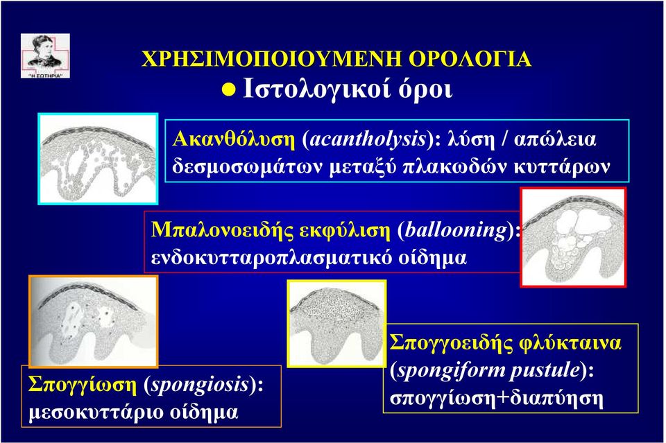 ενδοκυτταροπλασµατικό οίδηµα Σπογγίωση (spongiosis):