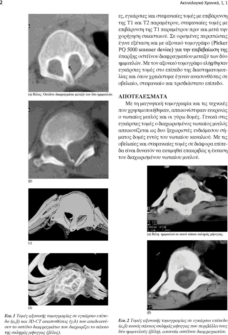 δύο ημιμυελών. Με τον αξονικό τομογράφο ελήφθησαν εγκάρσιες τομές στο επίπεδο της διαστηματομυελίας και όπου χρειάστηκε έγιναν ανασυνθέσεις σε οβελιαίο, στεφανιαίο και τρισδιάστατο επίπεδο.