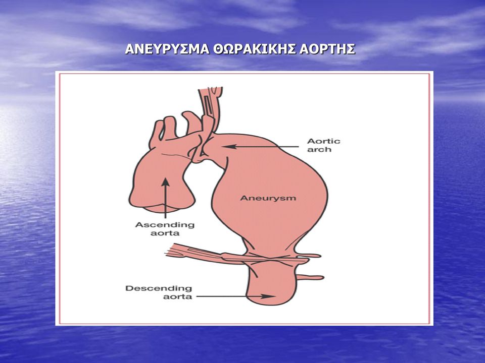 ΑΟΡΤΗΣ