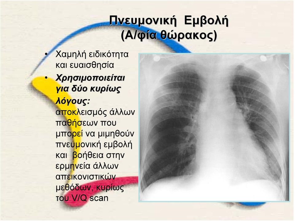 μιμηθούν πνευμονική εμβολή και βοήθεια στην ερμηνεία άλλων