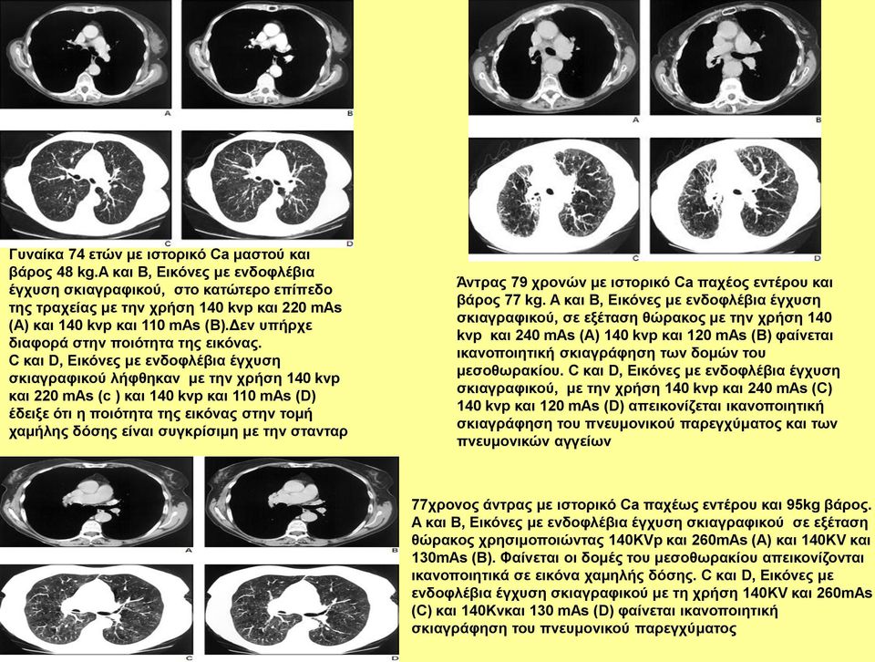 C και D, Eικόνες με ενδοφλέβια έγχυση σκιαγραφικού λήφθηκαν με την χρήση 140 kvp και 220 mas (c ) και 140 kvp και 110 mas (D) έδειξε ότι η ποιότητα της εικόνας στην τομή χαμήλης δόσης είναι