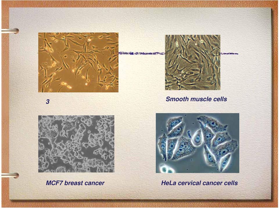 MCF7 breast cancer