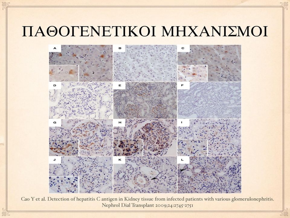 The pattern of HCV-NS3 antigen deposition in renal and hepatic specimens from negative control, positive control, disease control and HCVassociated GN.