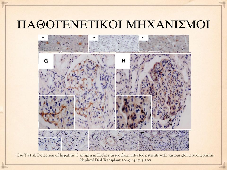 The pattern of HCV-NS3 antigen deposition in renal and hepatic specimens from negative control, positive control, disease control and HCVassociated GN.