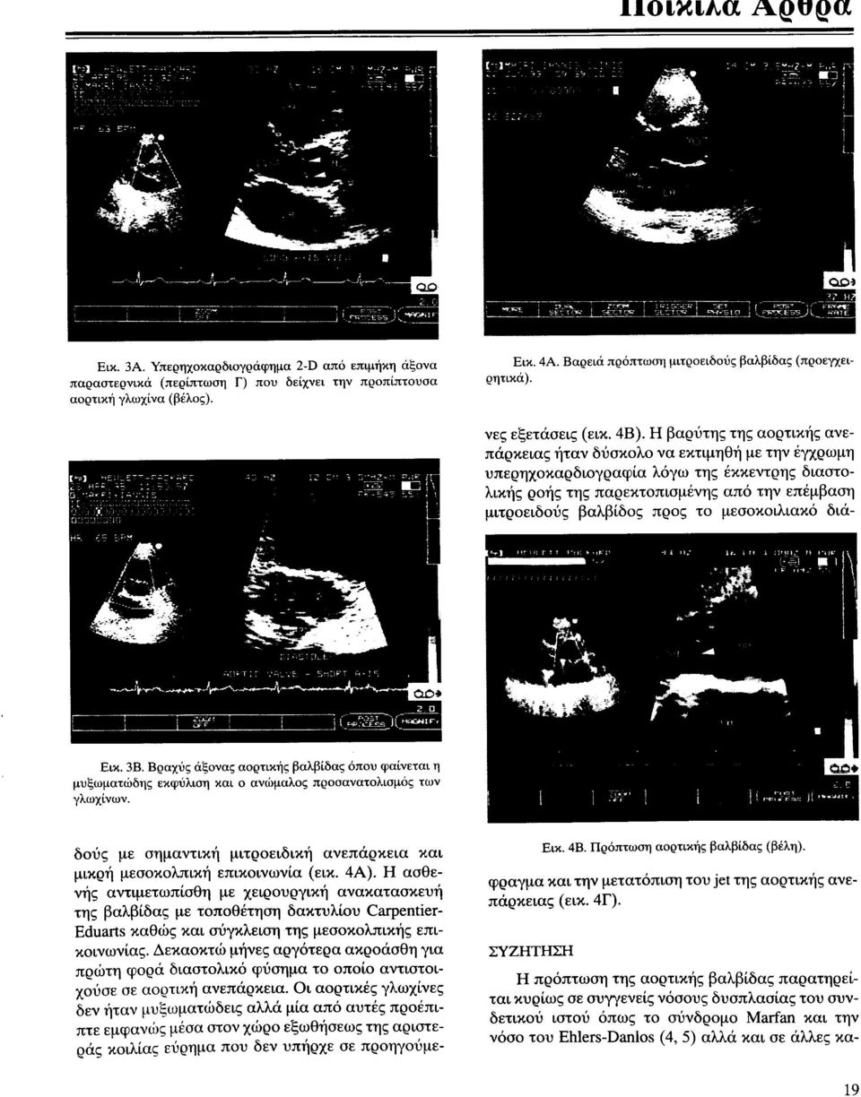 Η βαρύτης της αορτικής ανεπάρκειας ήταν δύσκολο να εκτιμηθή με την έγχρωμη υπερηχοκαρδιογραφία λόγω της έκκεντρης διαστολικής ροής της παρ εκτοπισμένης από την επέμβαση μιτροειδούς βαλβίδος προς το